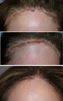 facial scars