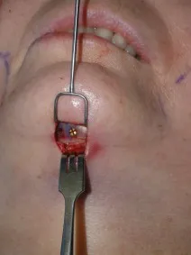 Chin & Lower Facial Implants
