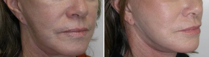 Pixie earlobe repaired by Dr Niamtu, original surgery done by another surgeon