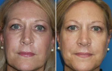 upper face filler in richmond