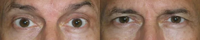 Excess eyelid skin after Botox injection