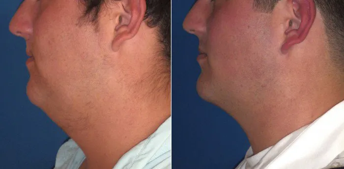 Submentoplasty case profile