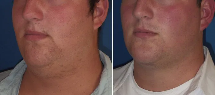 Submentoplasty case