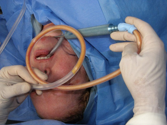 Submentoplasty fat removal
