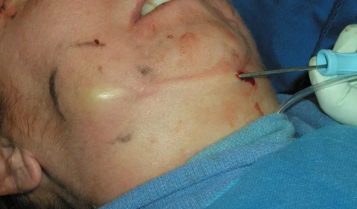 Submentoplasty fat removal
