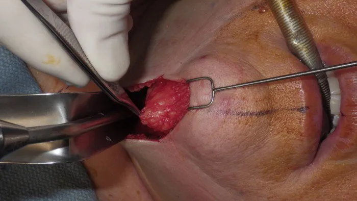 Submentoplasty fat removal