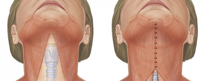Submentoplasty-illustration-Figure-1-24