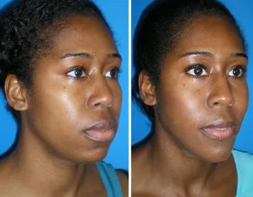 Before and after cheek implants and chin implants