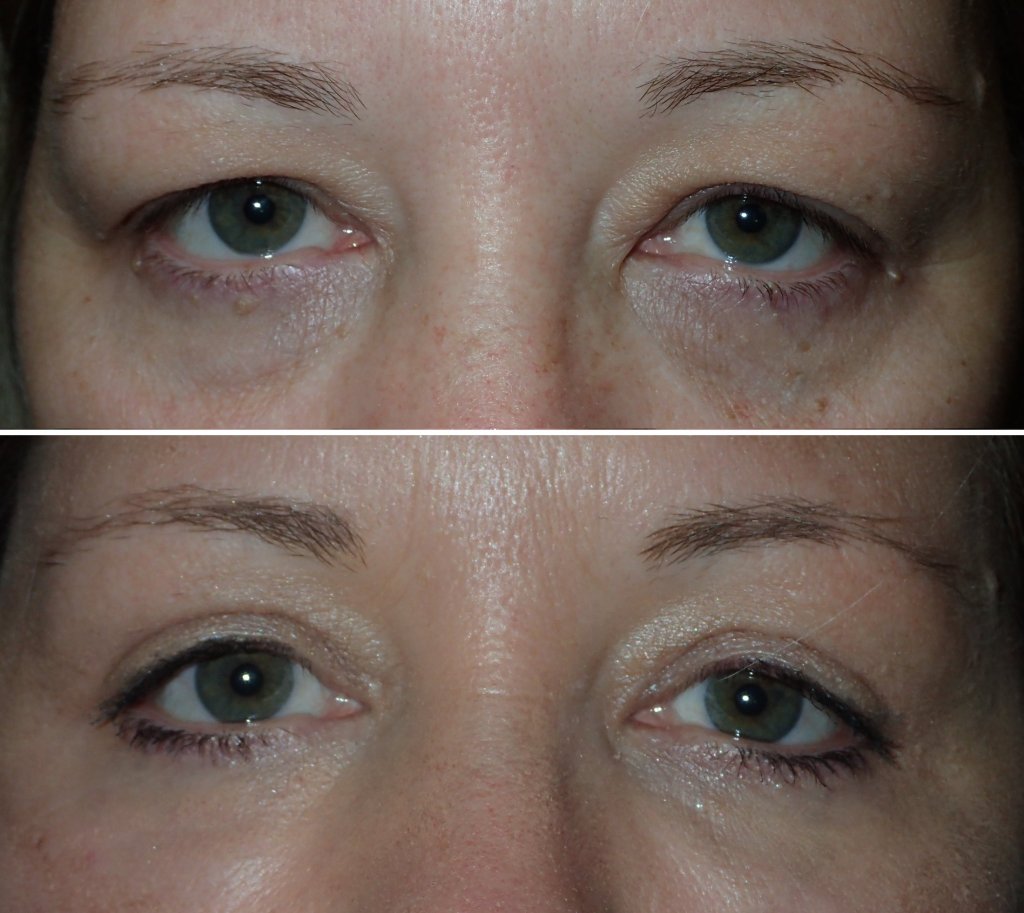 Eyelid Surgery in Richmond, VA