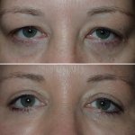 Eyelid Surgery in Richmond, VA