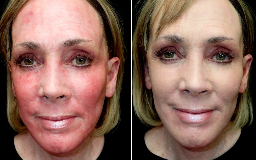 the skin is pink after treatment but is temporary