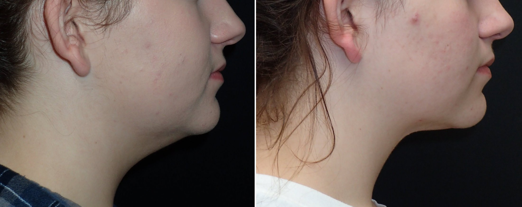 Face Liposuction Richmond VA Facial Liposuction Neck Liposuction