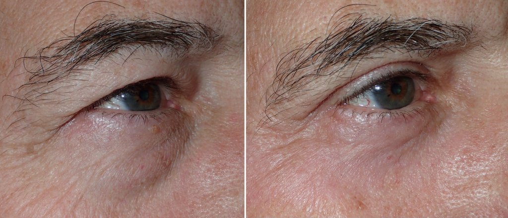 Eyelid Surgery in Richmond, VA