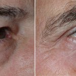 Eyelid Surgery in Richmond, VA