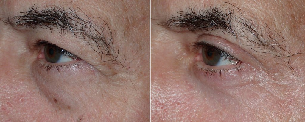 Eyelid Surgery in Richmond, VA