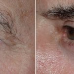Eyelid Surgery in Richmond, VA