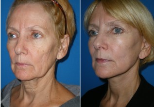 Video Testimonial for Richmond, VA Cosmetic Facial Surgery
