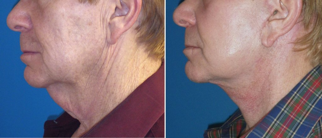 Facelifts for Men in Richmond