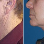 Facelifts for Men in Richmond