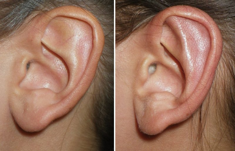 B - after Mustardé sutures to create the new antihelical fold and reposition the ear