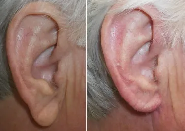 earlobe reduction in richmond, VA