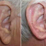 earlobe reduction in richmond