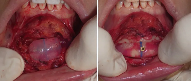 Chin & Lower Facial Implants