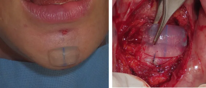 Chin & Lower Facial Implants