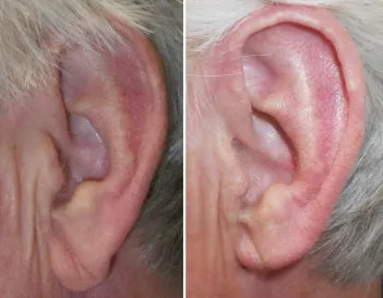 earlobe reduction in richmond, VA