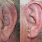 earlobe reduction in richmond