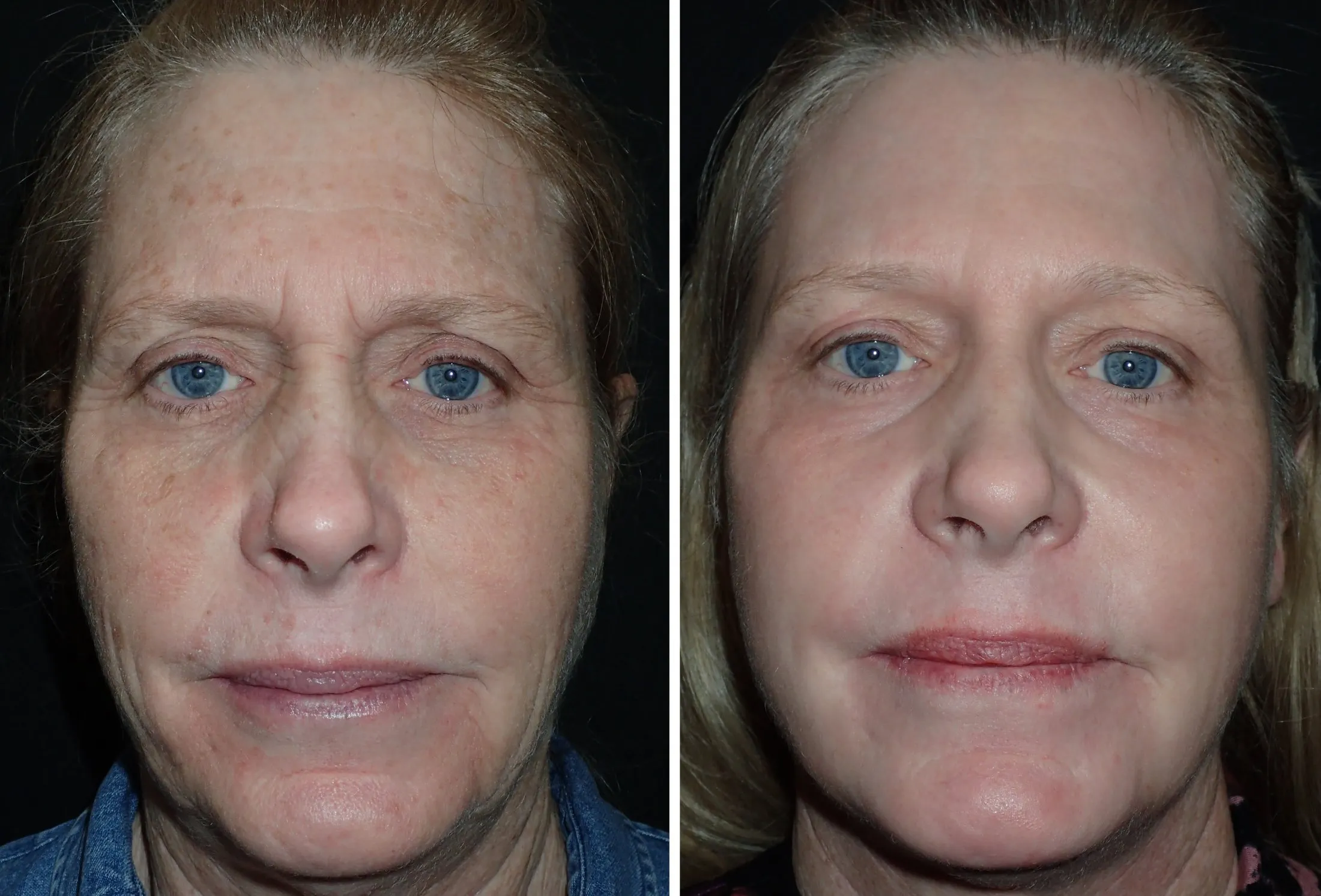 photos of before and after treatment for sun damage to skin