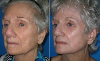 Laser resurfacing treatment