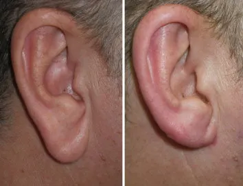 earlobe reduction in richmond