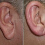 earlobe reduction in richmond