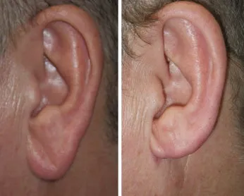 earlobe reduction in richmond, VA