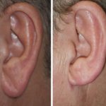 earlobe reduction in richmond