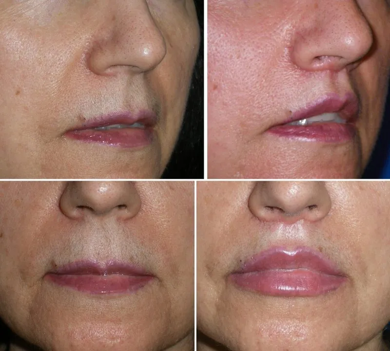 before and after lip lift
