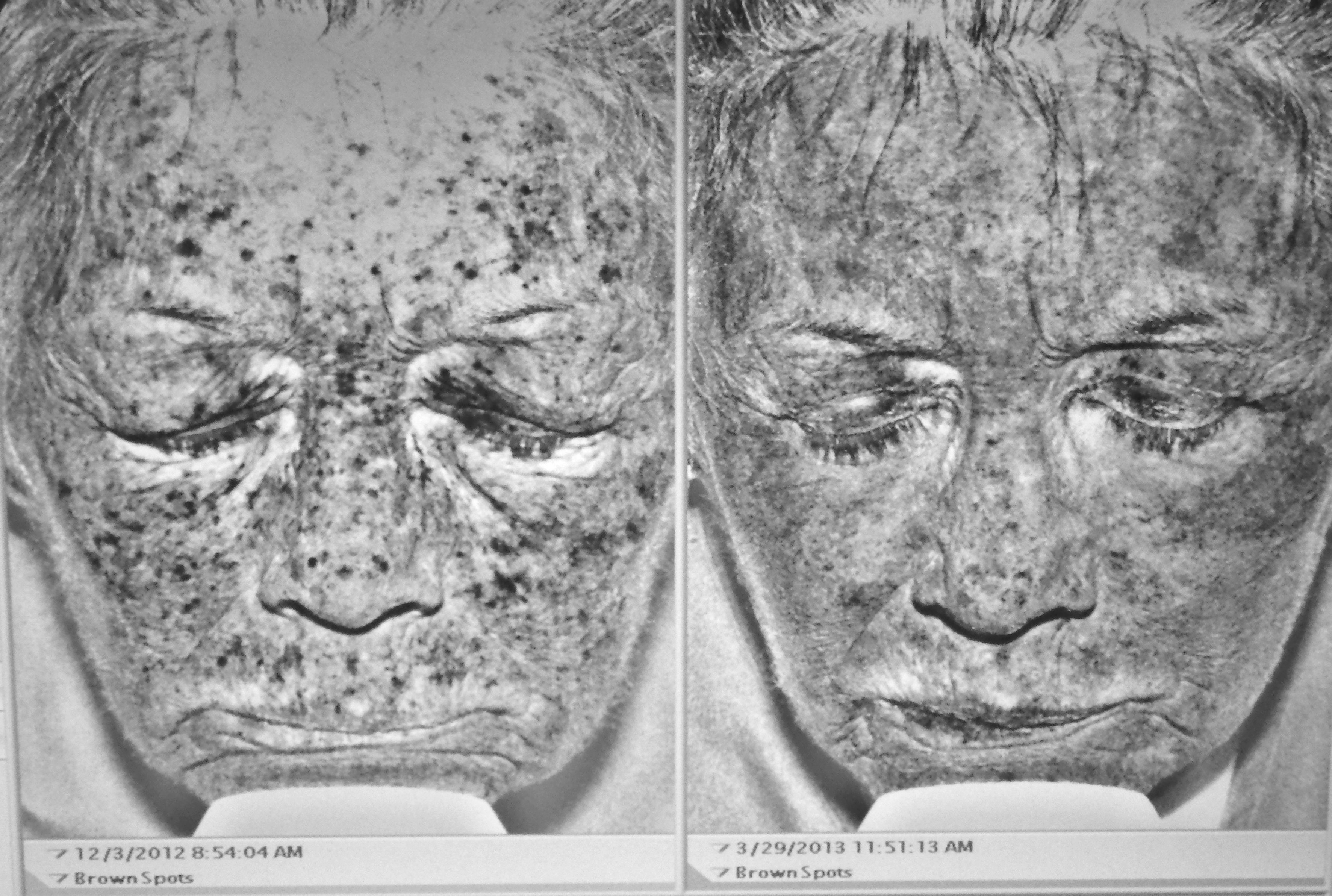 ultraviolet photography before (left) and after (right) CO2 laser resurfacing