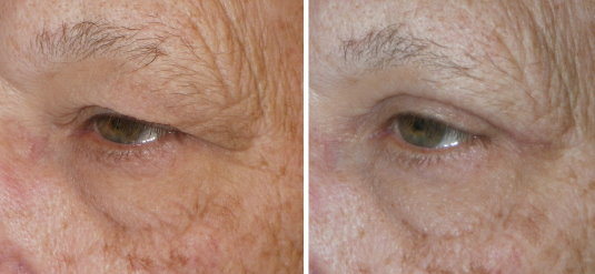 Eyelid Surgery in Richmond, VA
