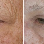Eyelid Surgery in Richmond, VA