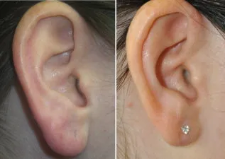 earlobe reduction