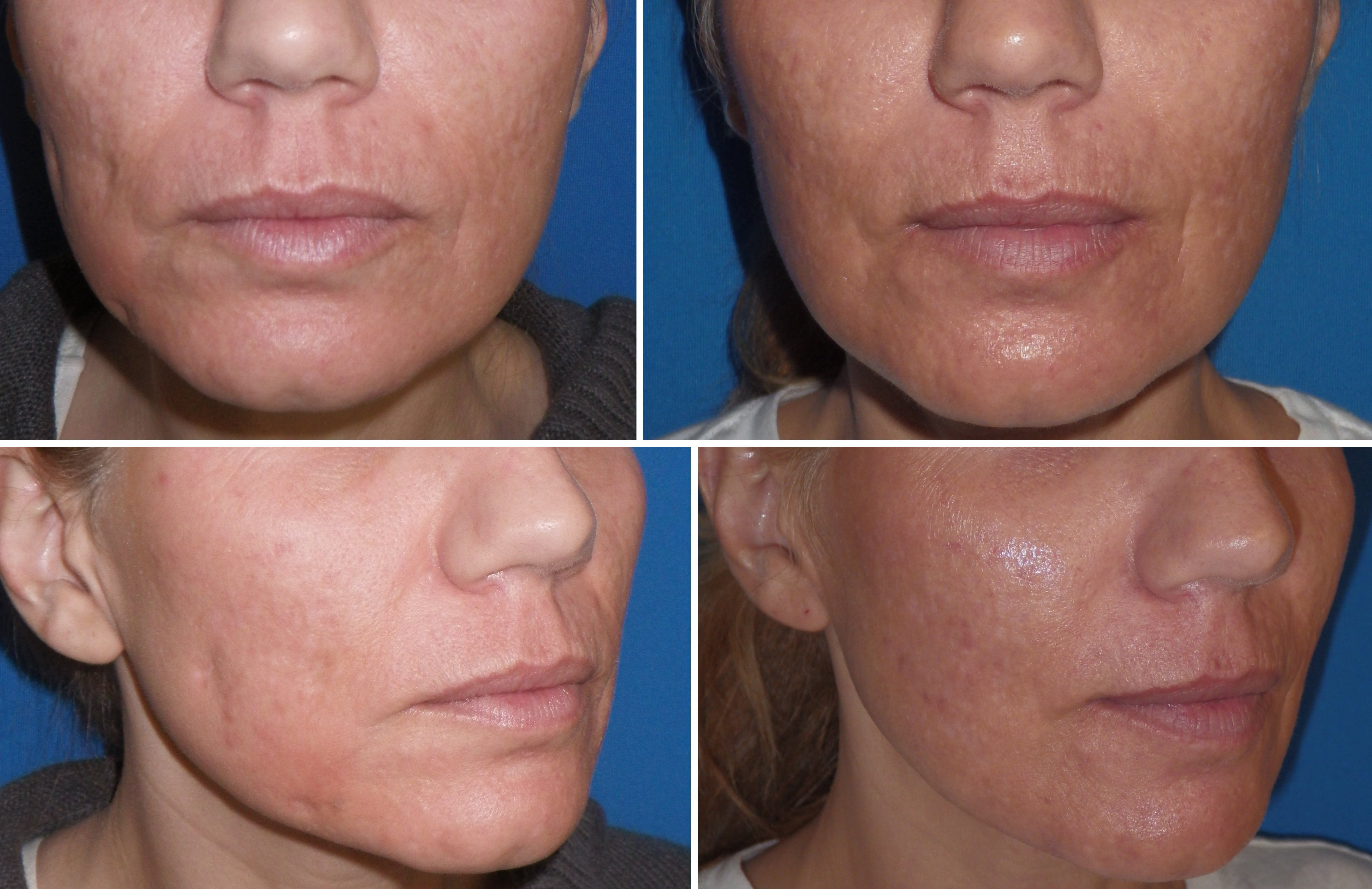 facial scar surgery in richmond