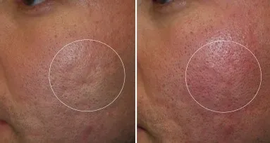 lower face fillers in richmond