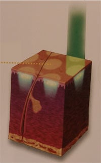 fractional laser treatment example - with dots