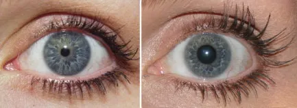 Before and after Latisse treatment photos of one of Dr. Niamtu's patients