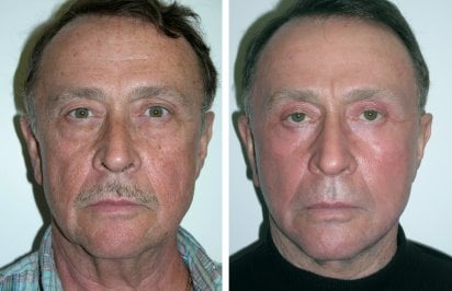 Laser resurfacing treatment and facelift