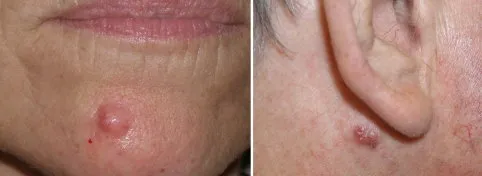 Mole Removal in Richmond