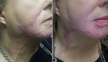Our first cautious treatment of Deborah which produced mild improvement and smoothing, follow up treatments are in the process