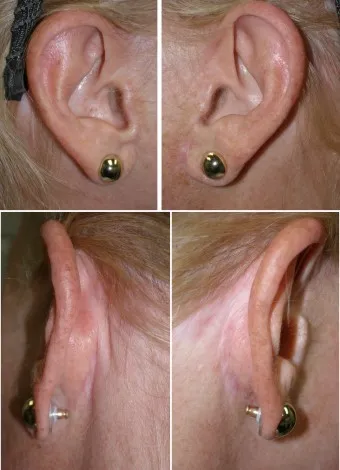 Healed facelift incision, Richmond VA