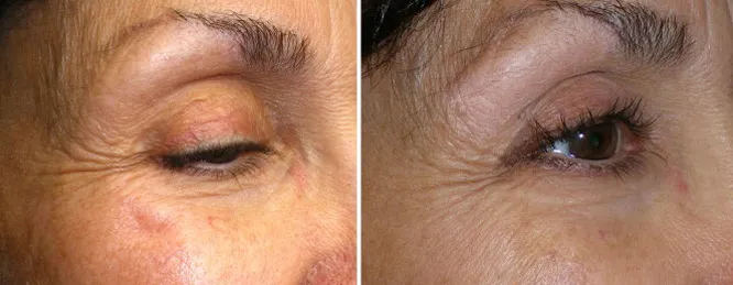 lower face fillers in richmond